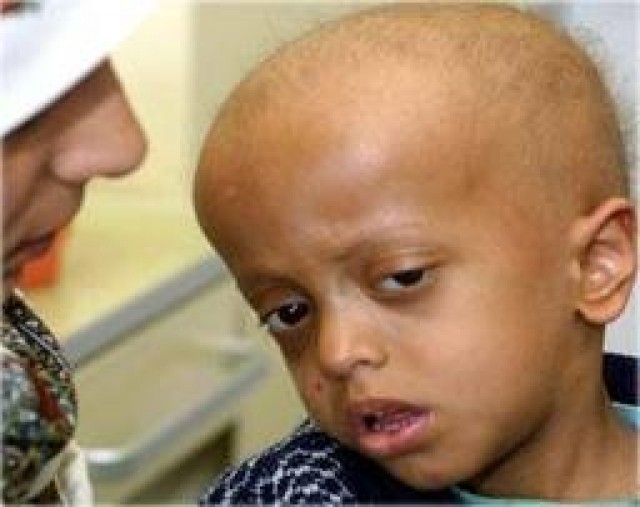 وفاة عشرات الأطفال من مرضى السرطان في صنعاء بسبب جرعة فاسدة من علاج السرطان